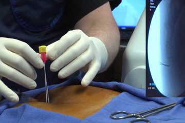Occipital Nerve Blocks